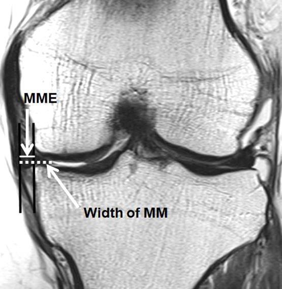 definitive joint space narrowing with moderate multiple osteophytes Gr 4 - severe joint space narrowing with cysts, and sclerosis 2.
