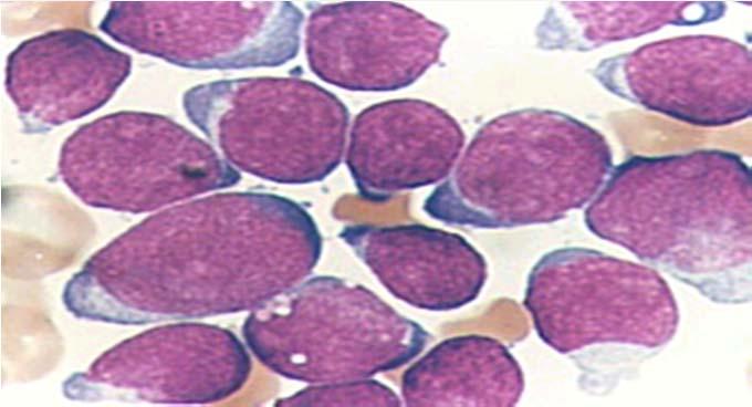 Myeloid Leukemia (AML) AML Chronic