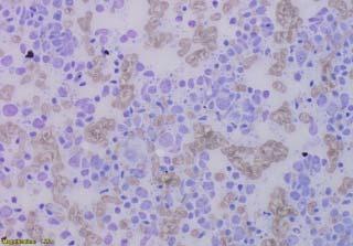 Modern Hematopathology Tissue pathology Molecular pathology Microscopy Immunophenotyping Karyotyping & FISH PCR & Sanger NGS WHO: