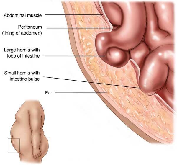 An umbilical hernia occurs when a tissue bulges out through an opening in time muscles on the abdomen near the navel or belly button (umbilicus). About 10% of abdominal hernias are umbilical hernias.
