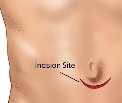 Treatment Options Surgical Procedure Open hernia repair - An incision is made near the sire. Your surgeon will repair the hernia with mesh or by suturing (sewing) the muscle layer closed.
