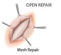 Mesh is often used for large hernia repairs and reduces the risk that the hernia will come back again. For all open repairs, the skin site is closed using sutures, staples, or surgical glue.