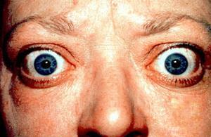 Graves disease Diffuse goiter + thyrotoxicosis + (in 40%) infiltrative ophthalmopathy (exophthalmos) + (in a minority of patients) infiltrative dermopathy (pretibial myxedema) *20-40 years *Women