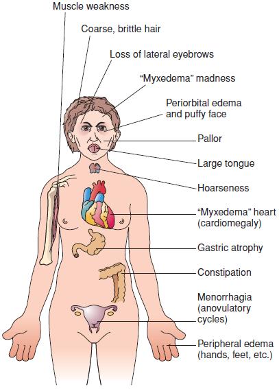 Clinical manifestations of hypothyroidism Cretinism in infancy or early childhood and myxedema in older