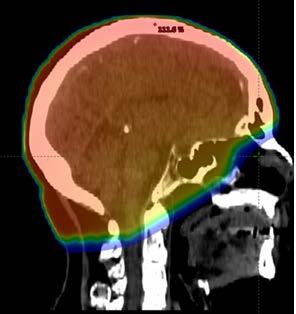 radical Whole-brain radiotherapy