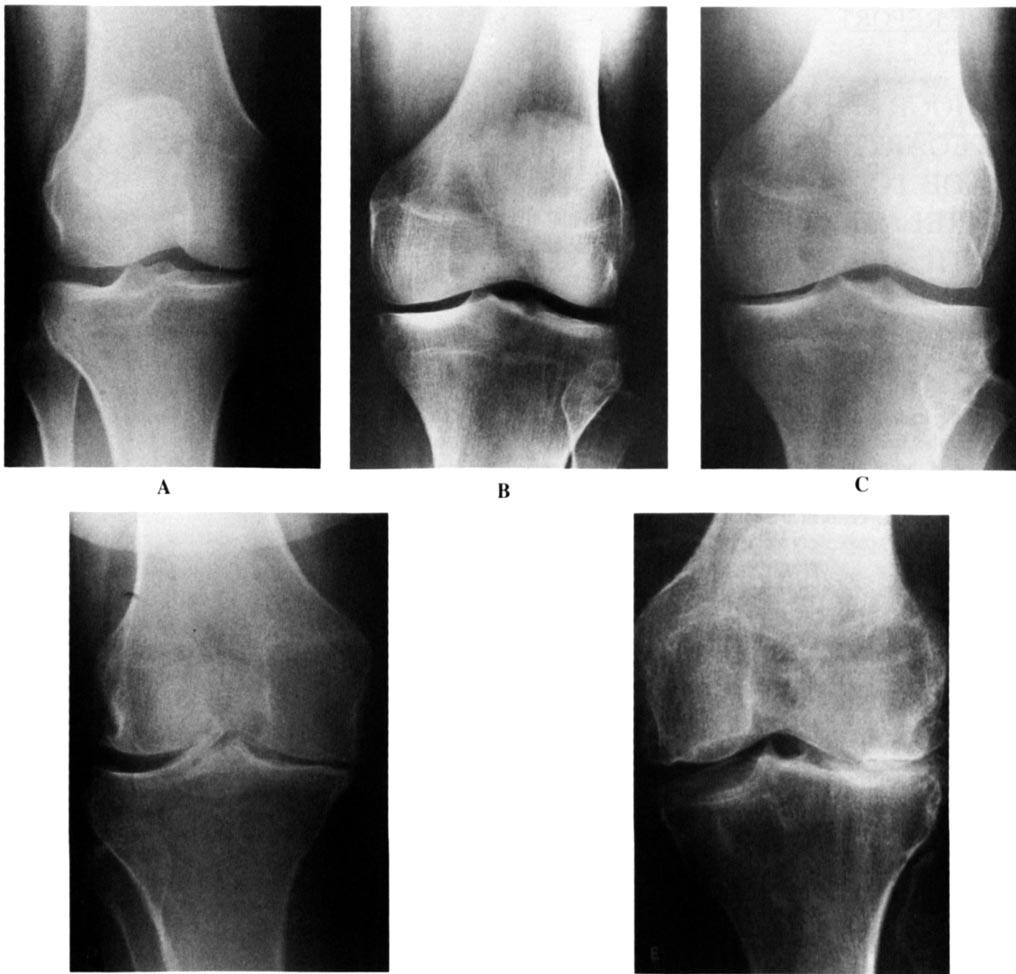 i82 BRIEF REPORT A B D E Figure 1. Standing anteroposterior knee radiographs demonstrating increasing severity of osteoarthritic changes, graded on a scoring sy!