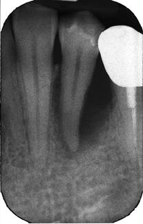 After endodontic tretment, the picl inflmmtion ws first llowed to hel nd the remining pocket treted with root deridement.