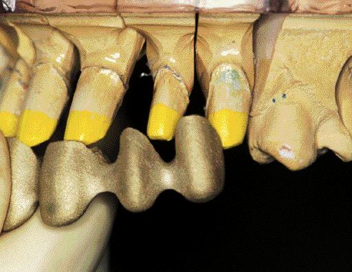 c d Fig. 4 () Tooth moility s result of dvnced periodontitis mde it impossile to prepre common pth of insertion.