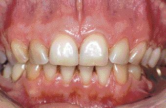Fig. 5 In the cse of 33-yer-old ptient with generlized ggressive periodontitis, periodontl tretment with susequent prosthetic restortion ws performed in 1992.