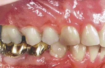 c CASE PRESENTATION: PERIODONTAL TREAT- MENT AND PROSTHETIC RESTORATION IN ADVANCED GENERALIZED AGGRESSIVE PERIODONTITIS Cse History This 33-yer-old womn ws referred to us y her dentist in 1992.