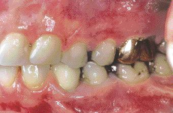 Dignosis The ptient s dentition ws in good condition in t e rms of conservtive nd prosthetic dentistry nd testified to good orl hygiene. The nterior gingiv ws unremrkle (Fig.
