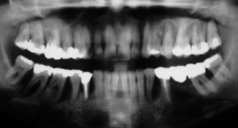 Fig. 6 The rdiogrph from 1992 shows severe dvnced one resorption in ll four qudrnts, with deep verticl defects, mrginl/picl confluent lightening nd notly lrge osteolytic centres on teeth 25, 27 nd 28.