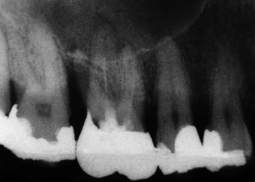 Fig. 7 () The 1992 rdiogrph shows furction involvement of tooth 16 with n incomplete endodontic filling nd picl lightening on ll three roots.