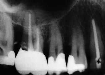 8 The 1992 rdiogrph shows() the extent of the extremely dvnced ggressive periodontitis in the second qudrnt. Only tooth 14 nd the pltl root of 16 re not ffected y complete ttchment loss.