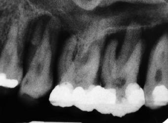 At tooth 34 connective tissue-like heling, ut no progressive one resorption, ws oserved in the distl one defect (Fig. 10).
