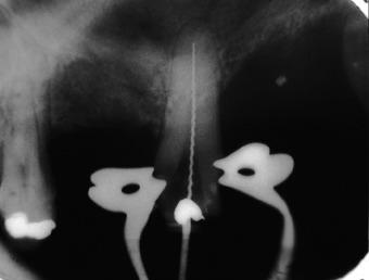 12) showed peripicl lesion of endodontic orgin on the rdectomied utments 46/47 nd verticl defect distlly of tooth 47.