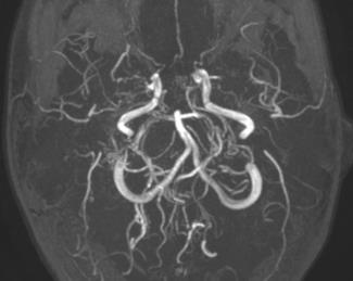 Moyamoya - continued The angiographic abnormalities may be the source of haemorrhage Retrospective study 44 patients on EBT, 19/44 moyamoya