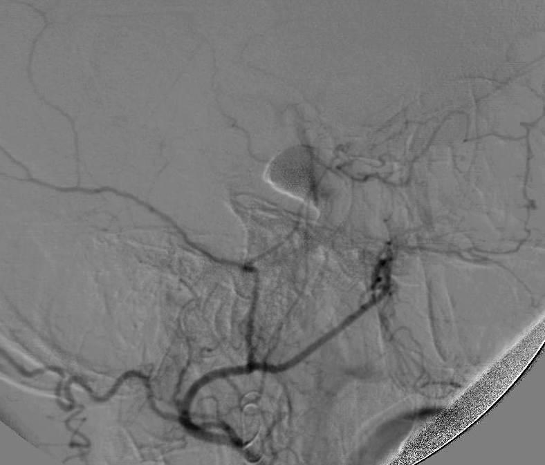 Parent artery coil occlusion