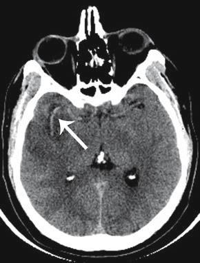 Early CT features Loss of