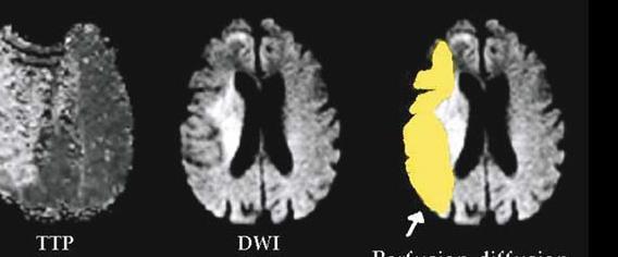 Wake up stroke: Patient went for sleep normal, wake up with hemi. Do not know time of onset Diffusion image: Detects (hyperintense) area of brain with diffusion deficit.