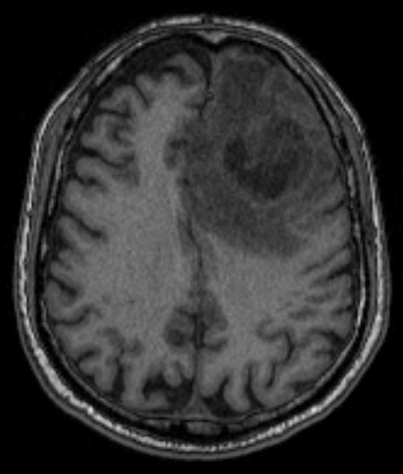 Here is a case you've already seen. This is a T1 sequence MRI. There is no contrast given yet.