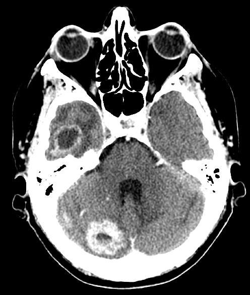 Notice at least 2 intracranial enhancing lesions.