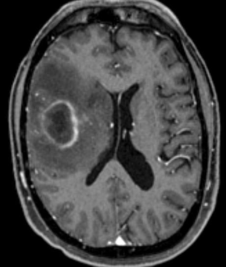 This is an example of an intracranial lesion.