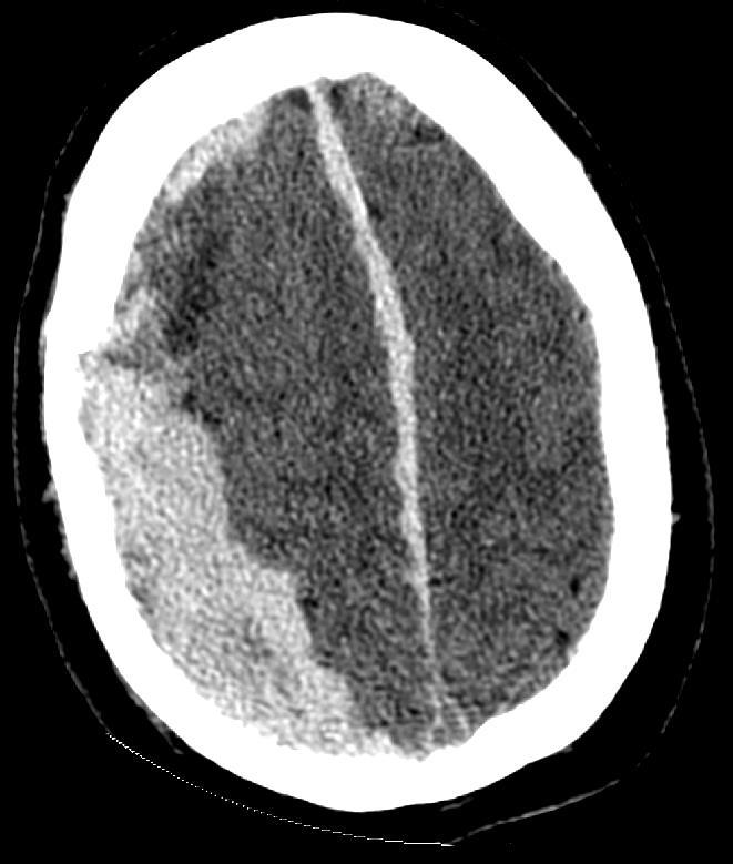 SDH Imaging Features Crescentic shape of hematoma Extra-axial, intra-dural Can cross the cranial sutures Cannot