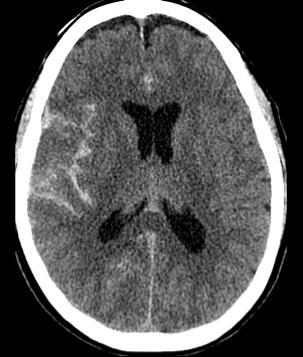 SAH Imaging Features Blood fills the gaps (sulci) between the brain cortex (gyri).