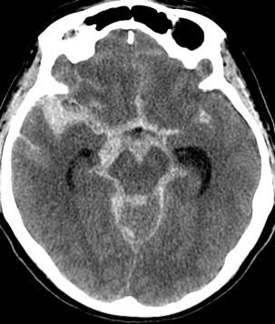SAH Here there is extensive acute SAH, including around the CSF cisterns surrounding the midbrain.