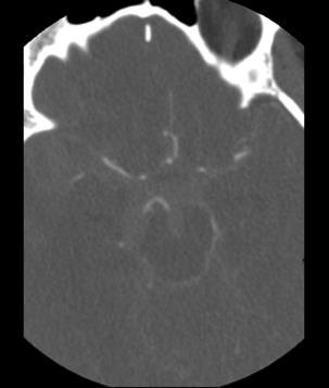 SAH This is a selected transverse axial slice of a CT angiogram.