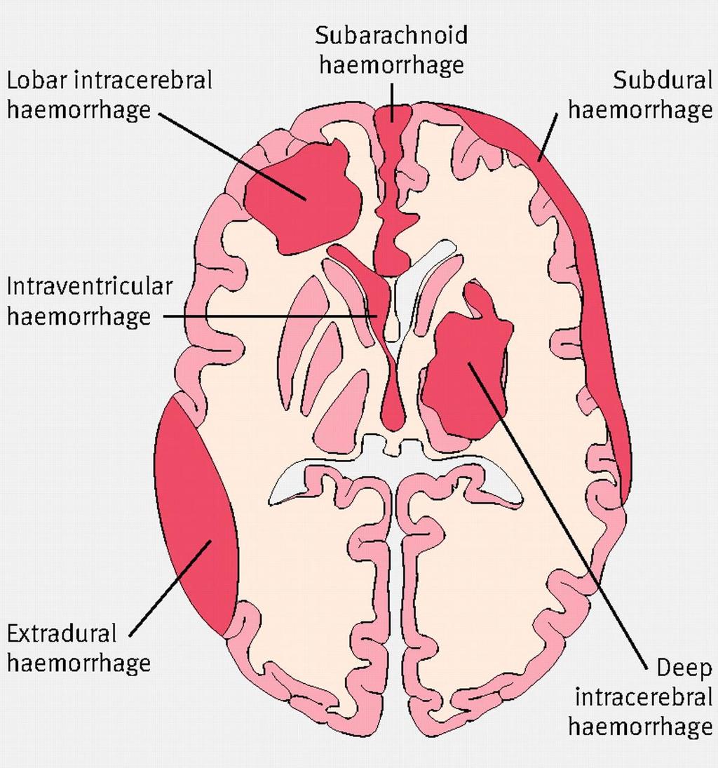 IPH Intraparenchymal Hemorrhage Common causes include trauma, tumor, hypertension,