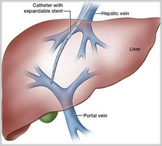 Variceal Haemorrhage TIPS (Transjugular Intrahepatic Portosystemic