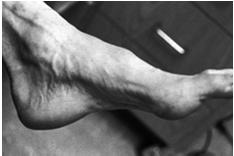 Neuropathy Atrophy of intrinsic foot muscles Preserved flexor muscle strength