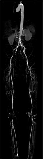 Angiography Diagnostic Therapeutic Complications nephrotoxicity contrast allergy