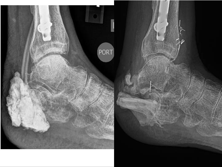 Hindfoot osteomyelitis a challenge met by all those treating the foot and ankle