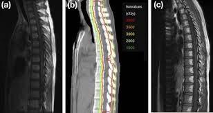Proton Cranio Spinal RT The Therapeutic Ratio Improving the therapeutic ratio: Increase separation of tumor control curve and toxicity curve Reduce toxicity: Significant reduction in volume of volume
