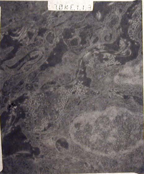 Electron Microscopy Tumor Tissue