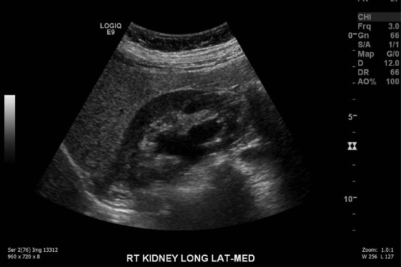 Figure 2. Longitudinal gray-scale image of the right kidney showing mild hydronephrosis. The results were conclusive for cervical cancer.