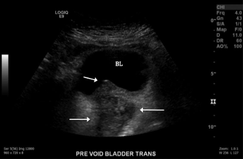 122 Journal of Diagnostic Medical Sonography 32(2) Figure 9. Transvaginal gray-scale sonogram showing metastases (arrows) within the bladder (BL) in the transverse plane. Table 1.