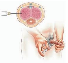 Figure 2 Helpful Hints It may take 4-8 injections to find the dose that causes an erection strong enough for