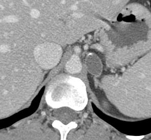 Other masses include the following: Adrenal cyst Can have features of simple cyst such as attenuation of less than 20 HU on unenhanced image and no enhancement following intravenous contrast
