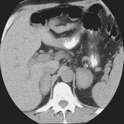 Note that qualitatively this area is of similar attenuation to the adjacent intra-abdominal fat. Figure 1.14 Bilateral adrenal hemorrhage.