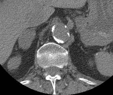 Axial unenhanced CT shows a right adrenal mass measuring Functioning and non-functioning adenomas, appear similar based on imaging as do Cushing s and Conn s adenomas.