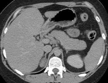 Axial unenhanced CT shows a right adrenal mass measuring