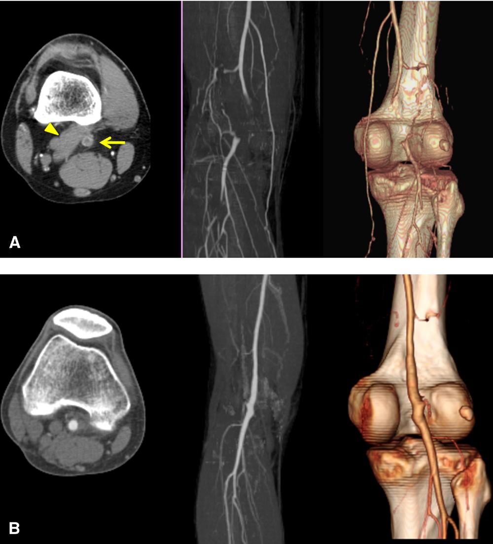 Volume 55, Number 1 Kim et al 93 Fig 1. Three-dimensional computed tomography angiography (CTA) shows popliteal entrapment syndrome (type I).