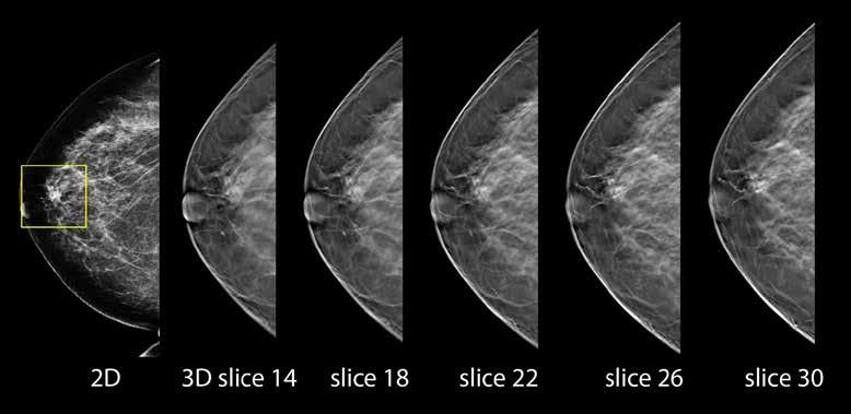 A 3D mammography exam may be used as a screening tool in conjunction with a traditional digital mammogram or may be used by itself for a diagnostic mammogram.