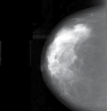 Digital Mammography Digital (computerized) mammography is similar to standard mammography in that X-rays are used to produce detailed images of the breast.