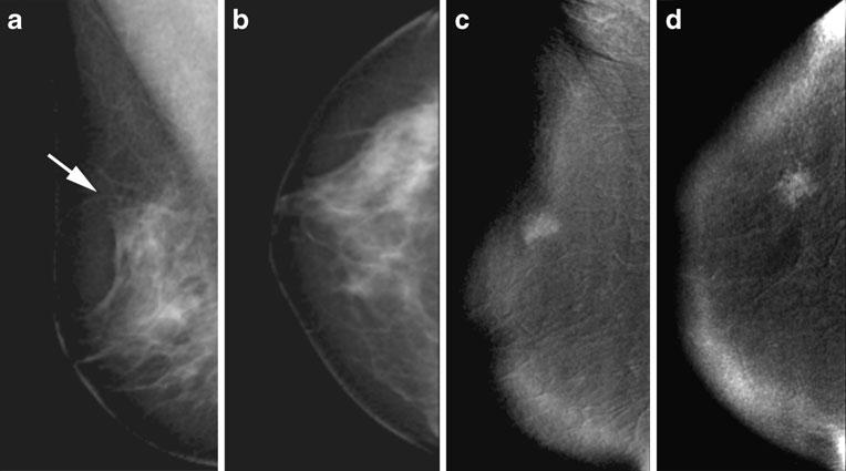 Eur Radiol (2011) 21:565 574 571 Table 6 Assessment of the number of lesions by each imaging technique in multifocal carcinomas MX mammography, US ultrasound, CEDM contrastenhanced digital