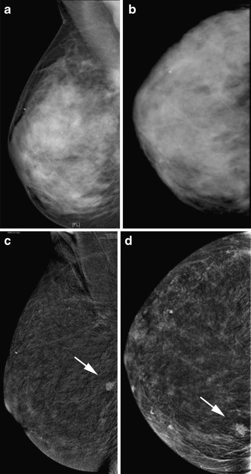 In this potential indication CEDM has the advantage of being a fast imaging technique with immediate availability in the mammography suite without a new appointment and without loss of time.